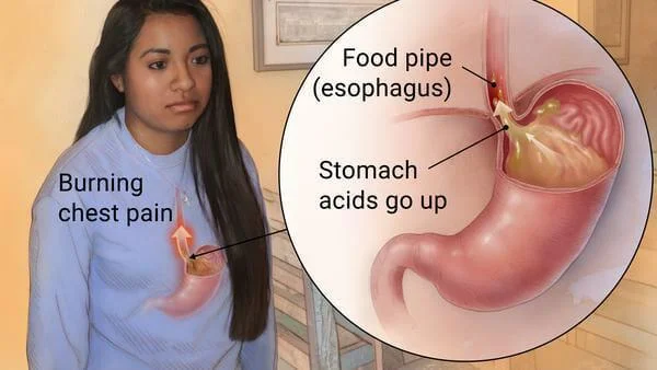stomach acid pain